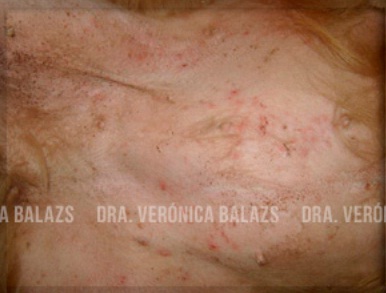 Foliculitis superficial, fácil de diagnosticar, por la presencia de lesiones primarias: pústulas y pápulas