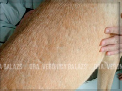 Sin título Perro de pelo corto con la presentación “apolillada” de foliculitis superficial.