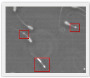 Sin título Figura 2 . Espermatozoides con formas anormales. Gota citoplasmática distal y cola en látigo.