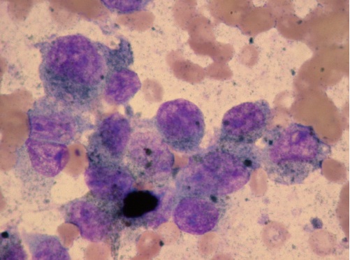 Citología de melanoma oral donde se pueden observar los tipicos granulos de malanina en el citoplasma de los melanocitos