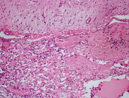 Sin título Figura3: Meningitis fibrinosa (H&E)